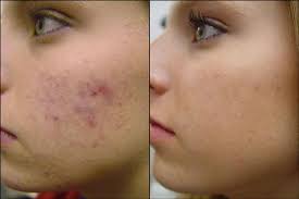 dermatologue-laser-acne.jpg