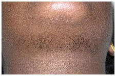 dermatologue-laser-vincennes-pilosite-avant.jpg